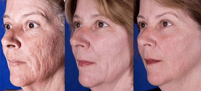 Rezultatul după întinerirea pielii faciale cu laser