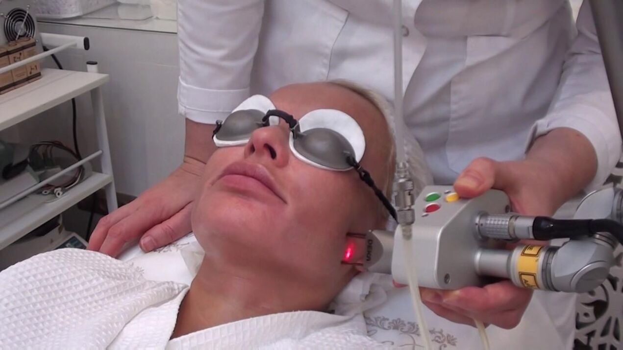 Tratament cu rază laser pe zonele cu probleme ale pielii feței