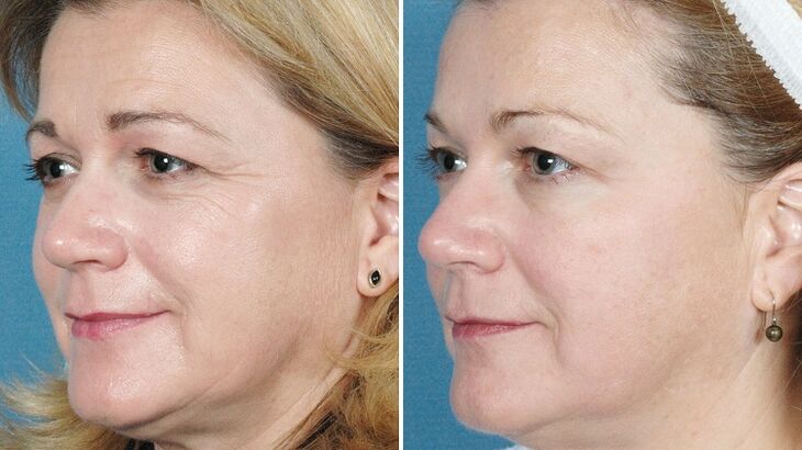 Fotografii înainte și după întinerirea pielii