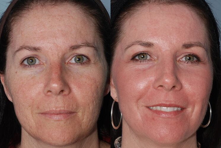 înainte și după întinerirea pielii